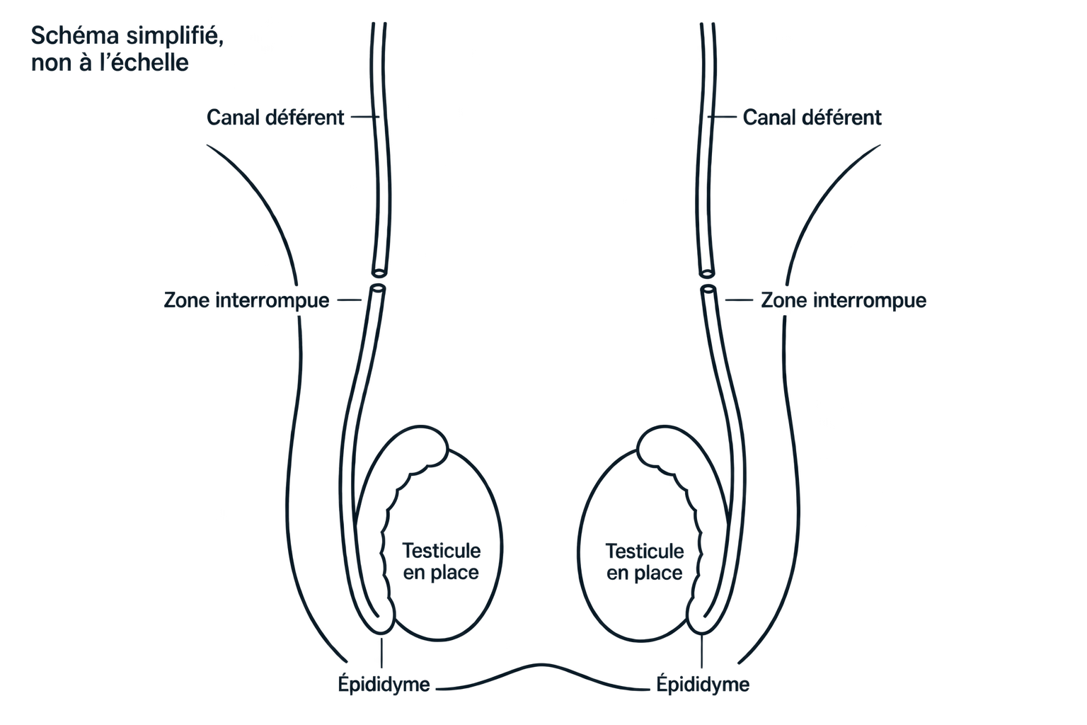 Schéma simplifié : canaux déférents interrompus, testicules en place